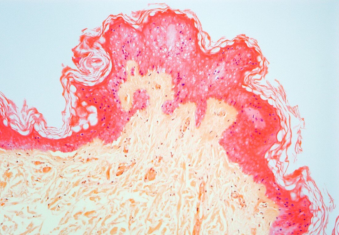 Skin necrosis,light micrograph