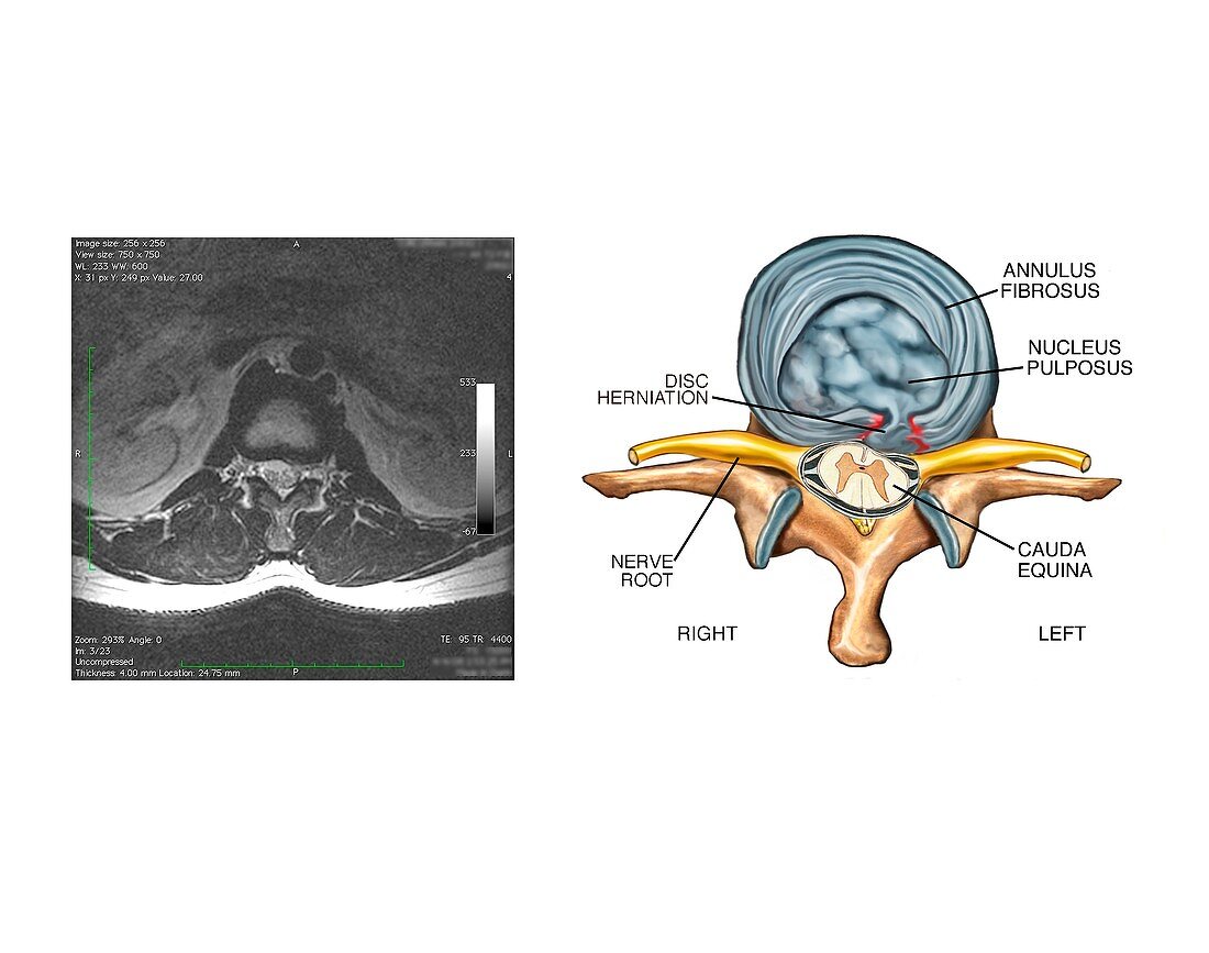 Slipped disc in the lumbar spine