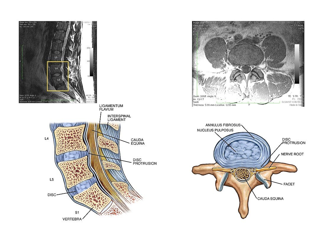 Protruding disc in the lumbar spine