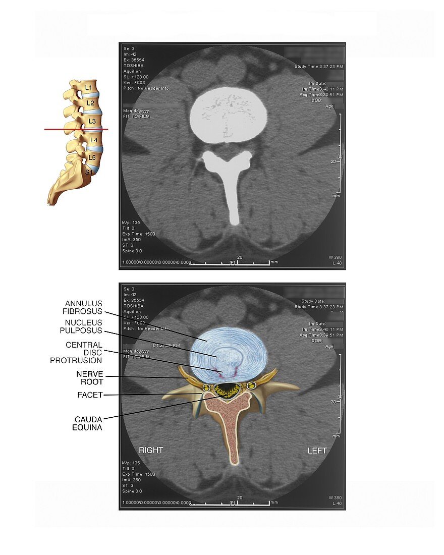 Protruding disc in the lumbar spine