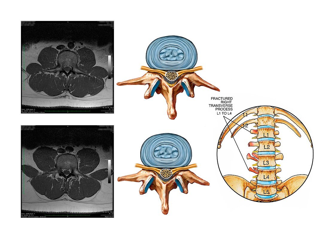 Fractured lumbar vertebral processes