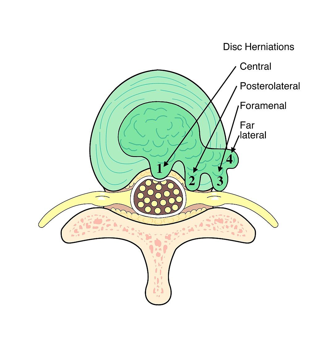 Types of herniated intervertebral discs