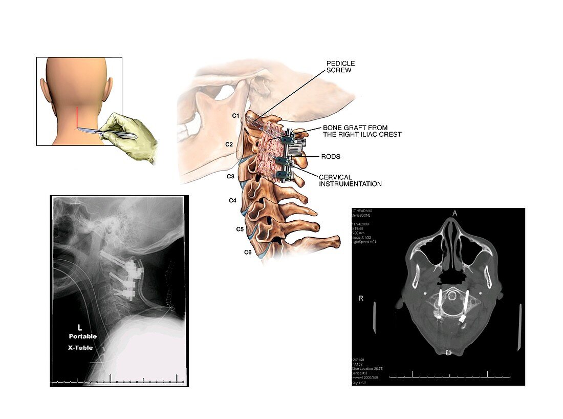 Surgery to fuse the cervical spine
