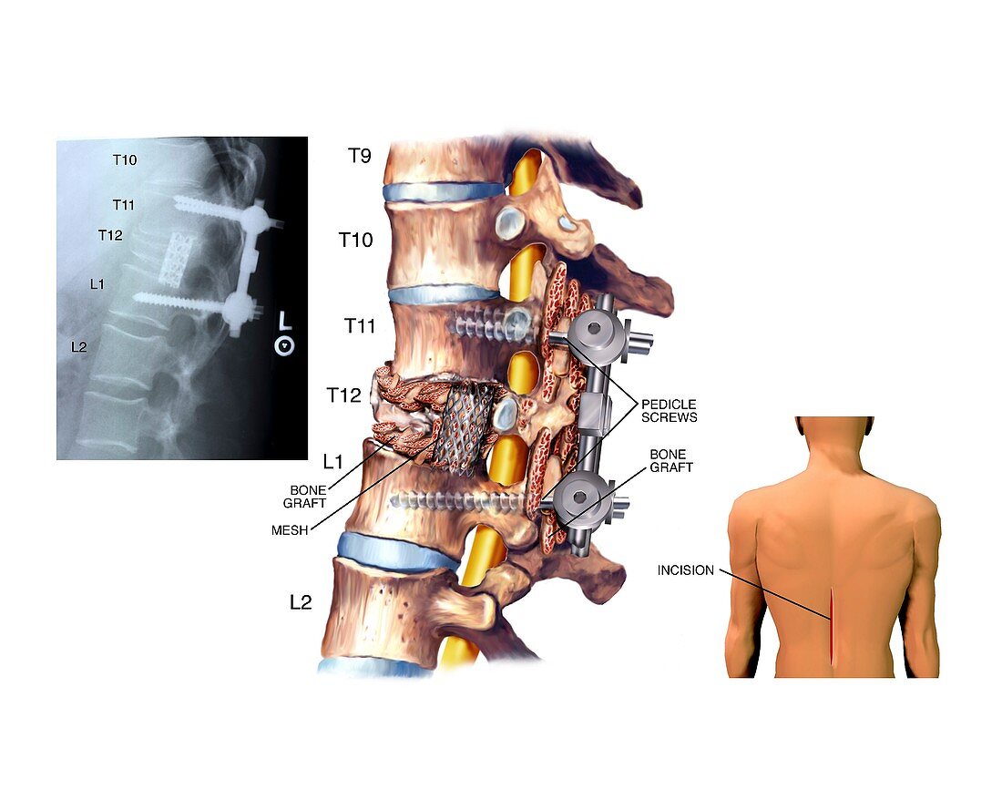Surgery to fuse the thoracic spine