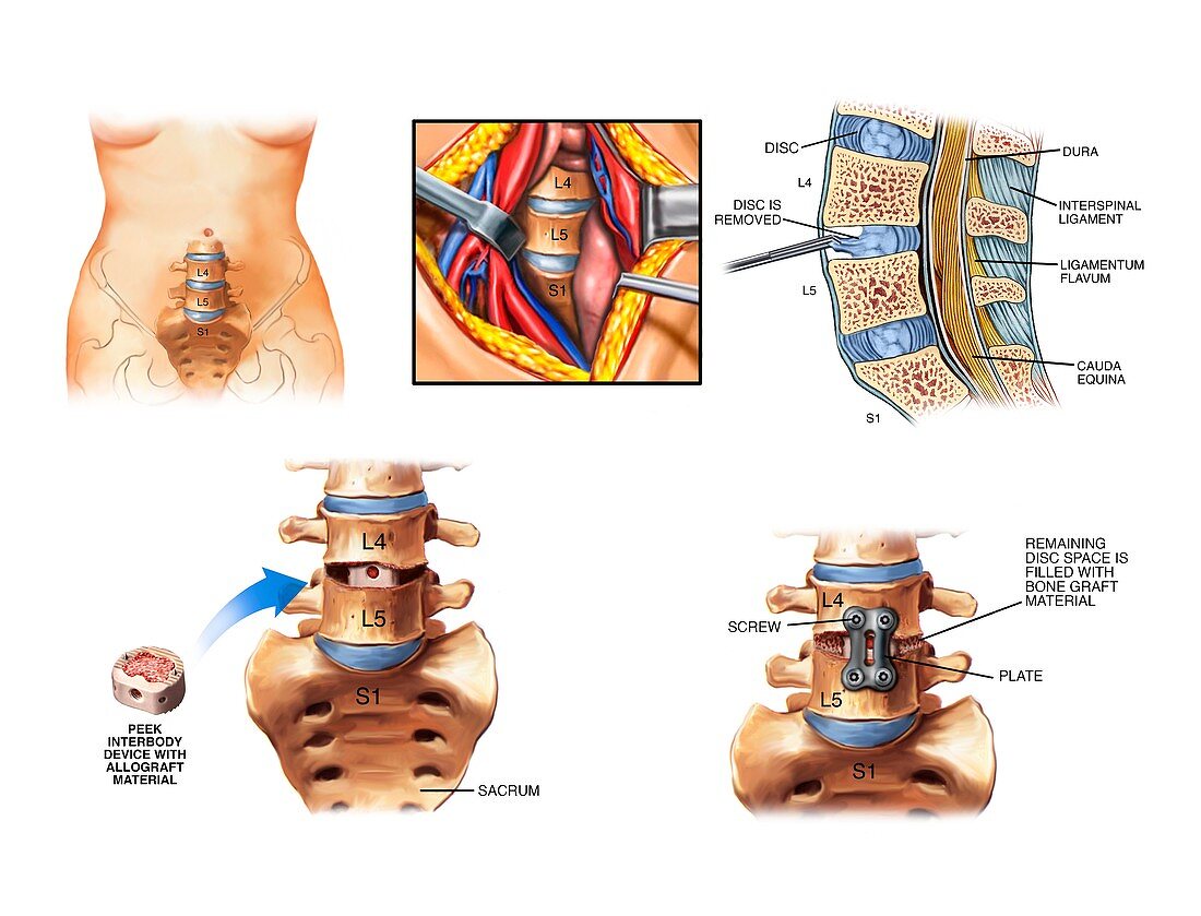 Surgery to fuse the lumbar spine