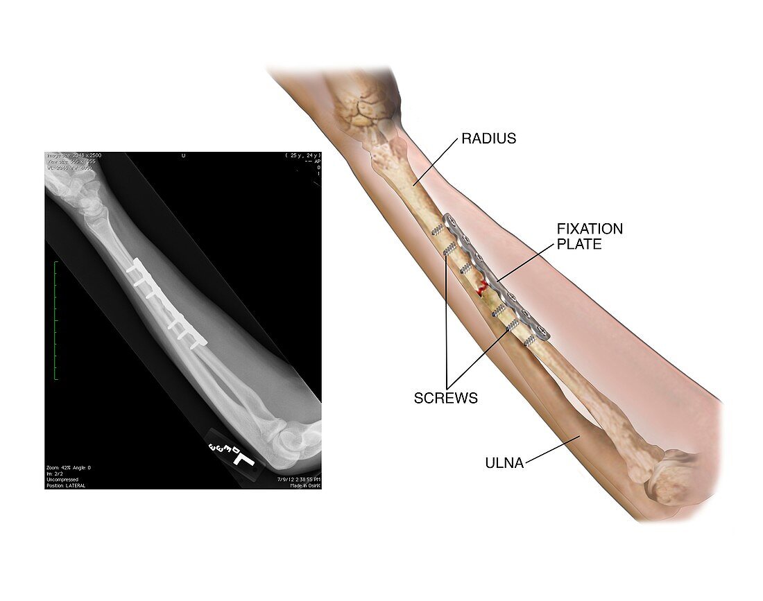 Internal fixation of fractured radius