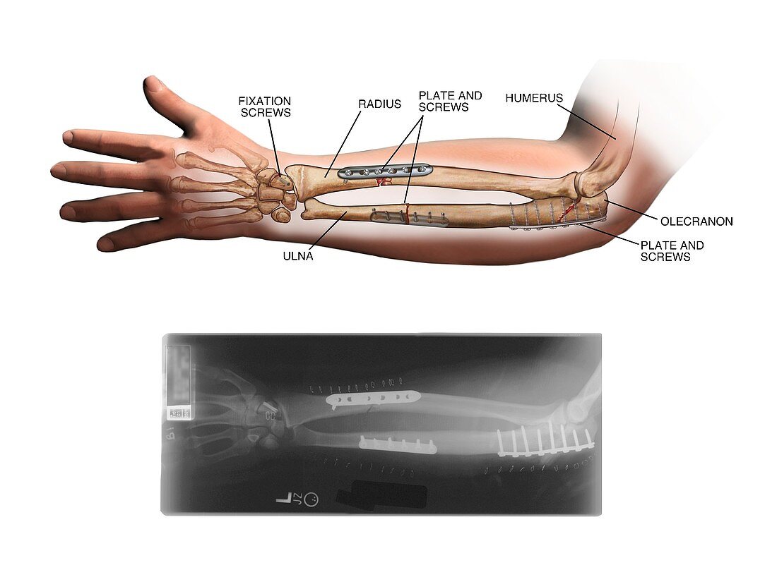 Internal fixation of fractured arm bones