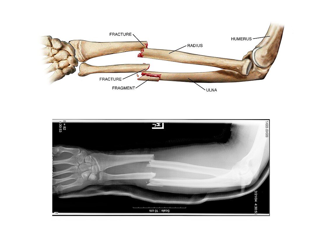 Comminuted fractures of arm bones