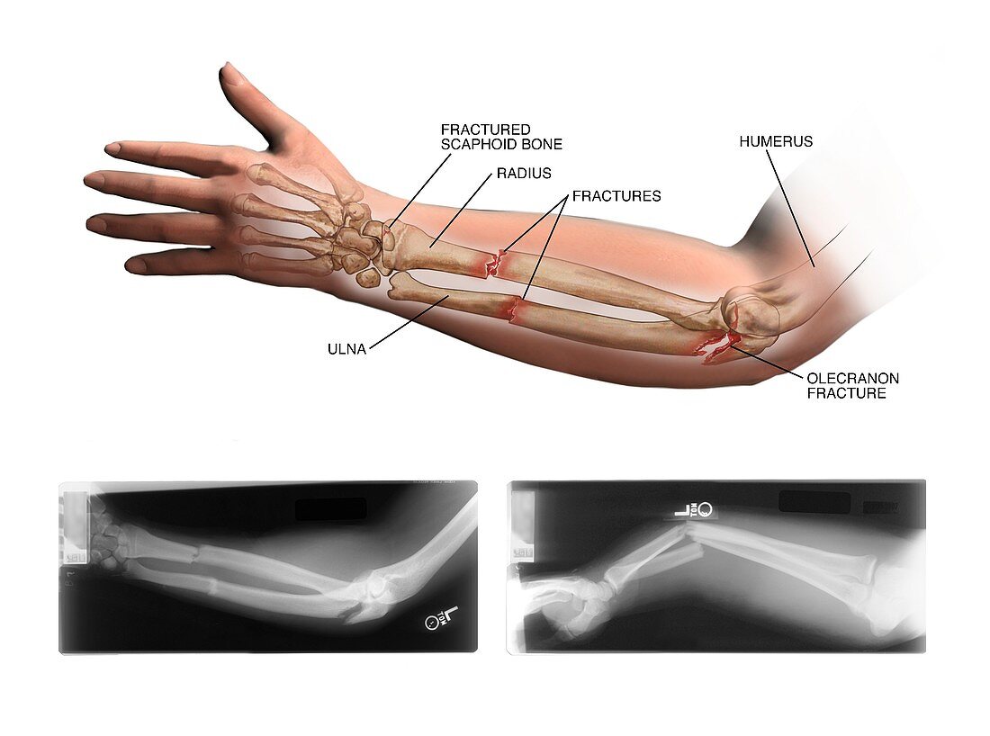Fractured arm and wrist bones
