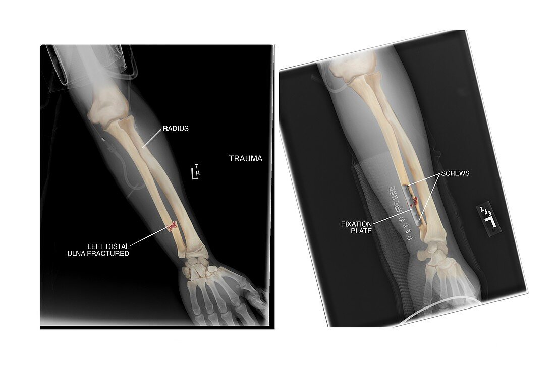 Fractured ulna bone and fixation,X-rays