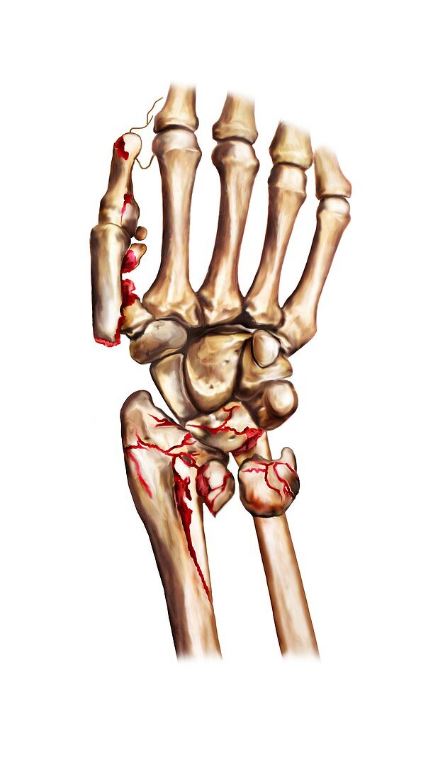 Fractured wrist and thumb bones,artwork