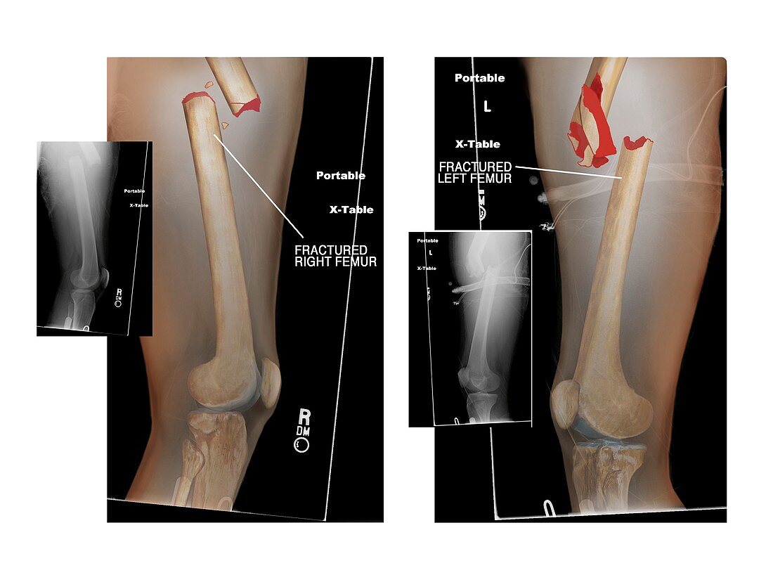 Fractures of right and left femurs