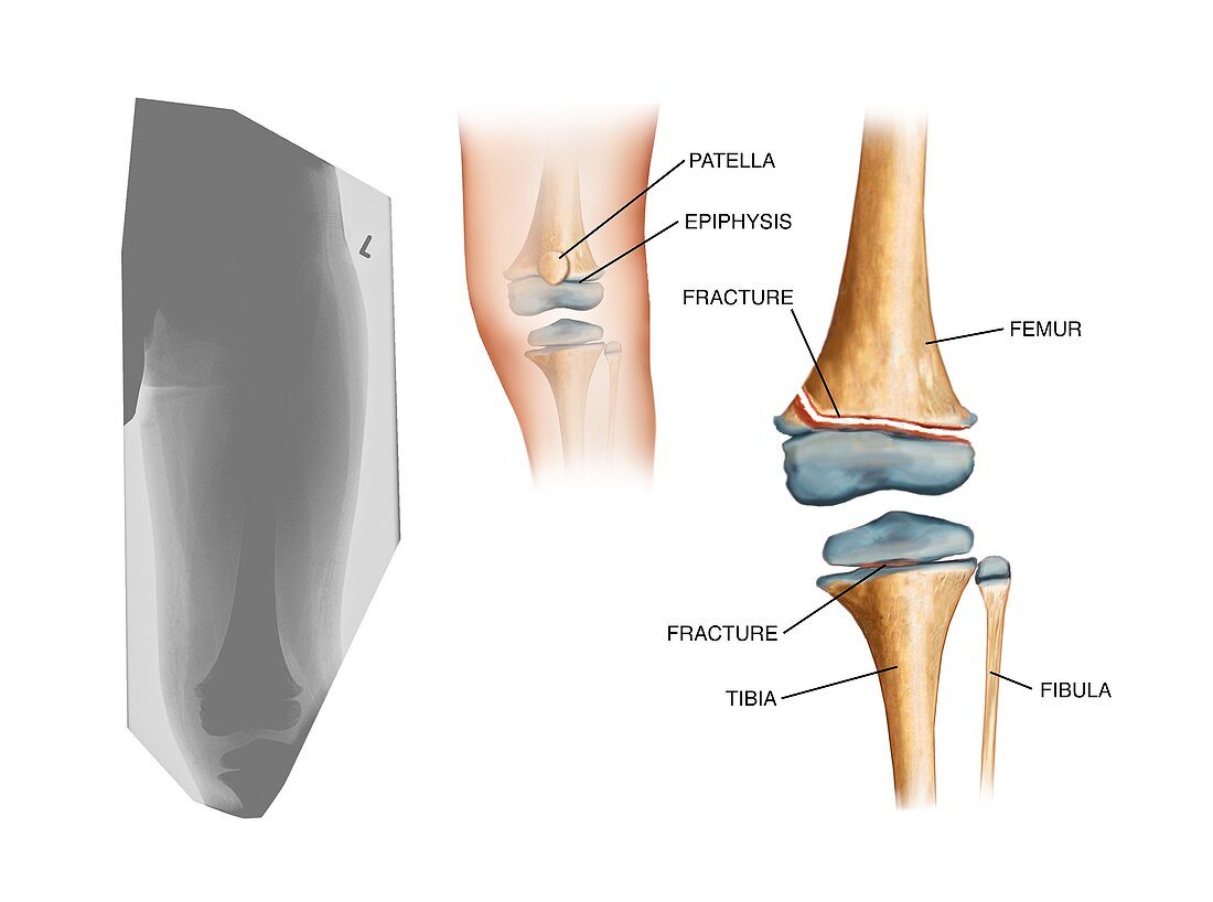 Type II Salter fracture in the knee