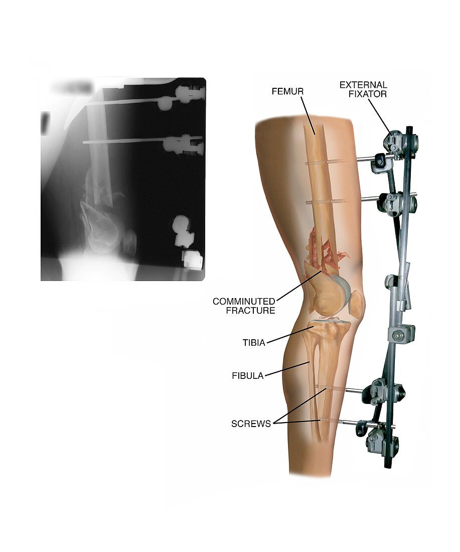External fixation of fractured femur