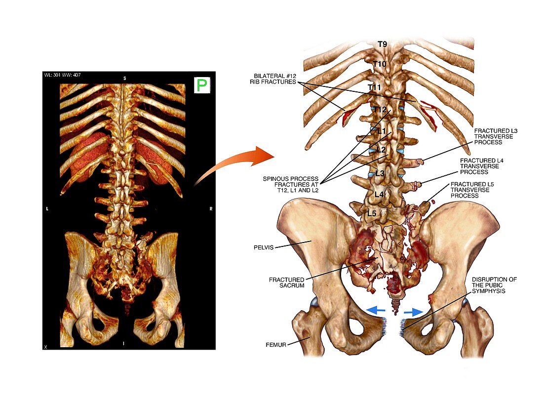 Fractured pelvis and spine