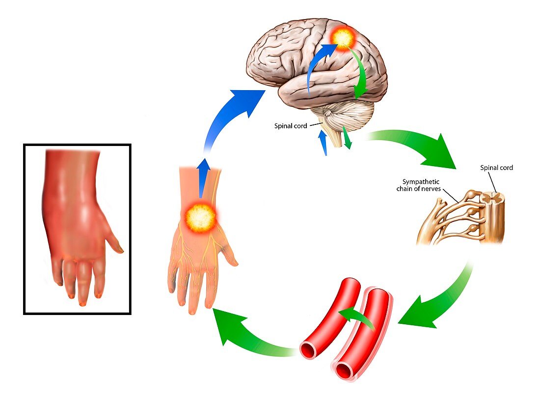 Complex regional pain syndrome