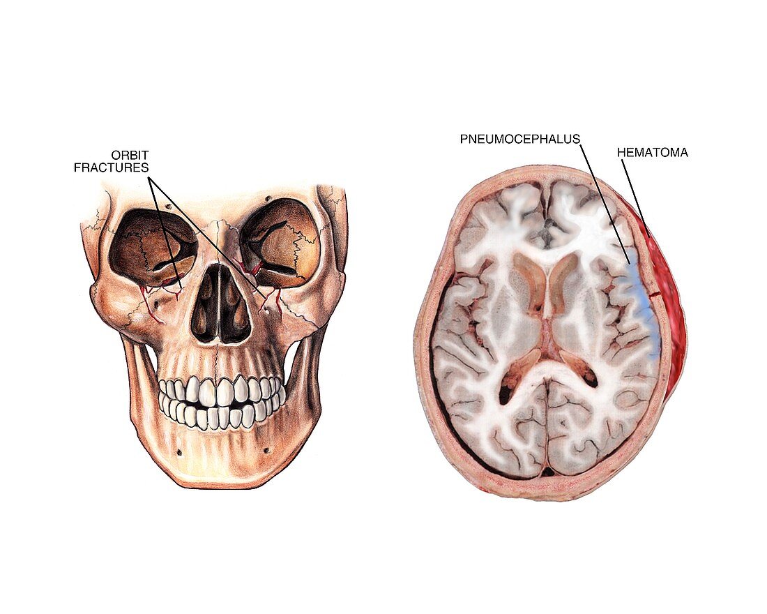 Facial fractures and brain injuries