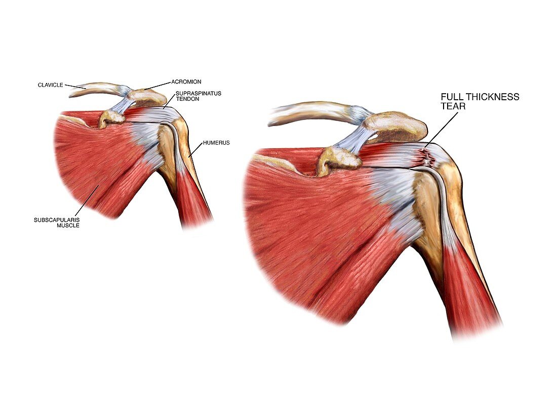 Shoulder tendon injury