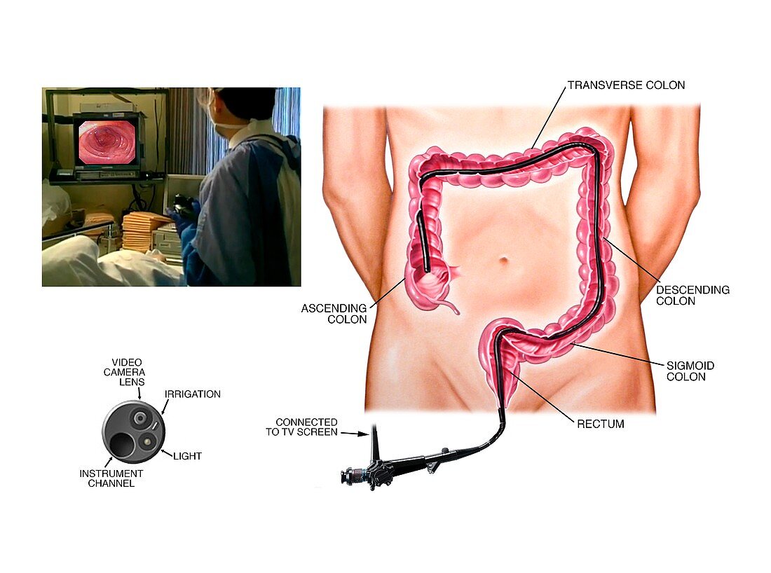 Colonoscopy procedure