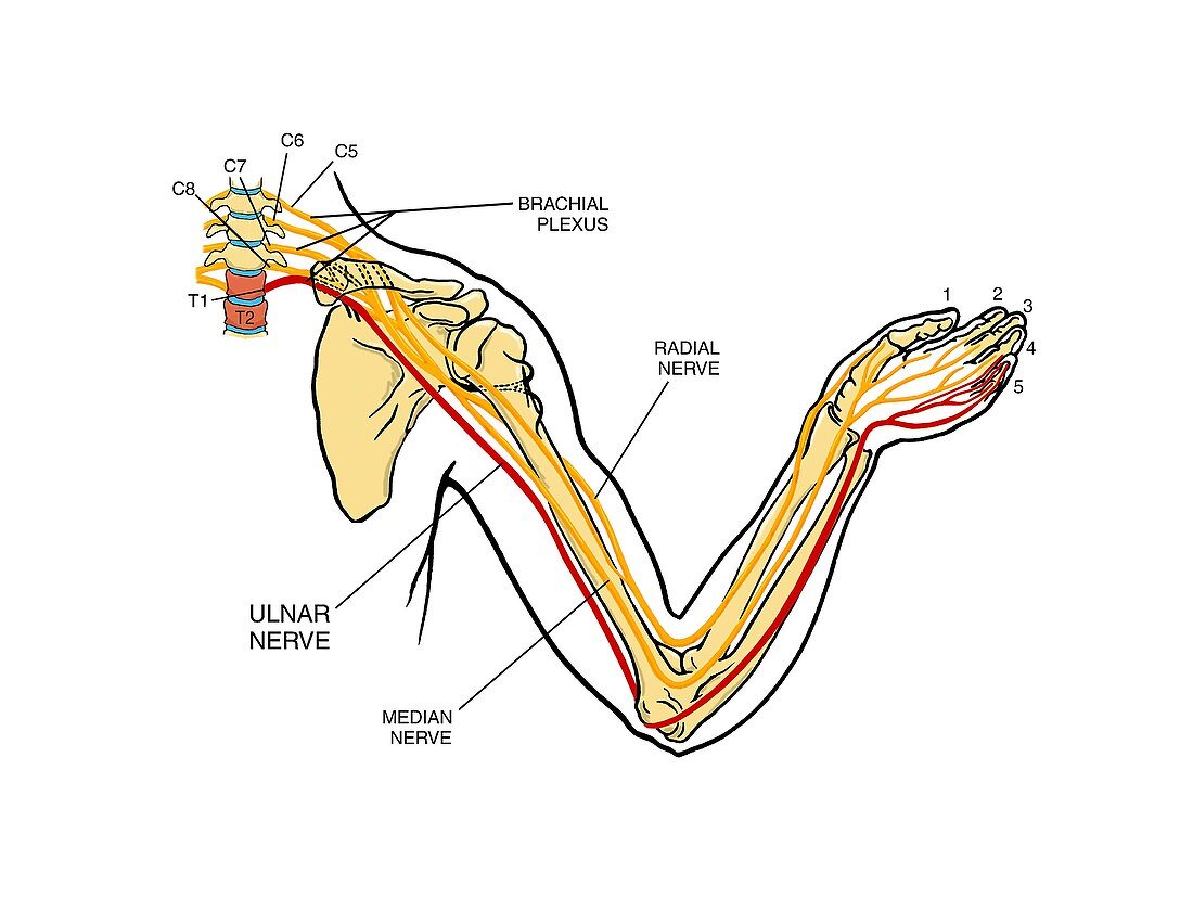 Brachial plexus arm nerve injury
