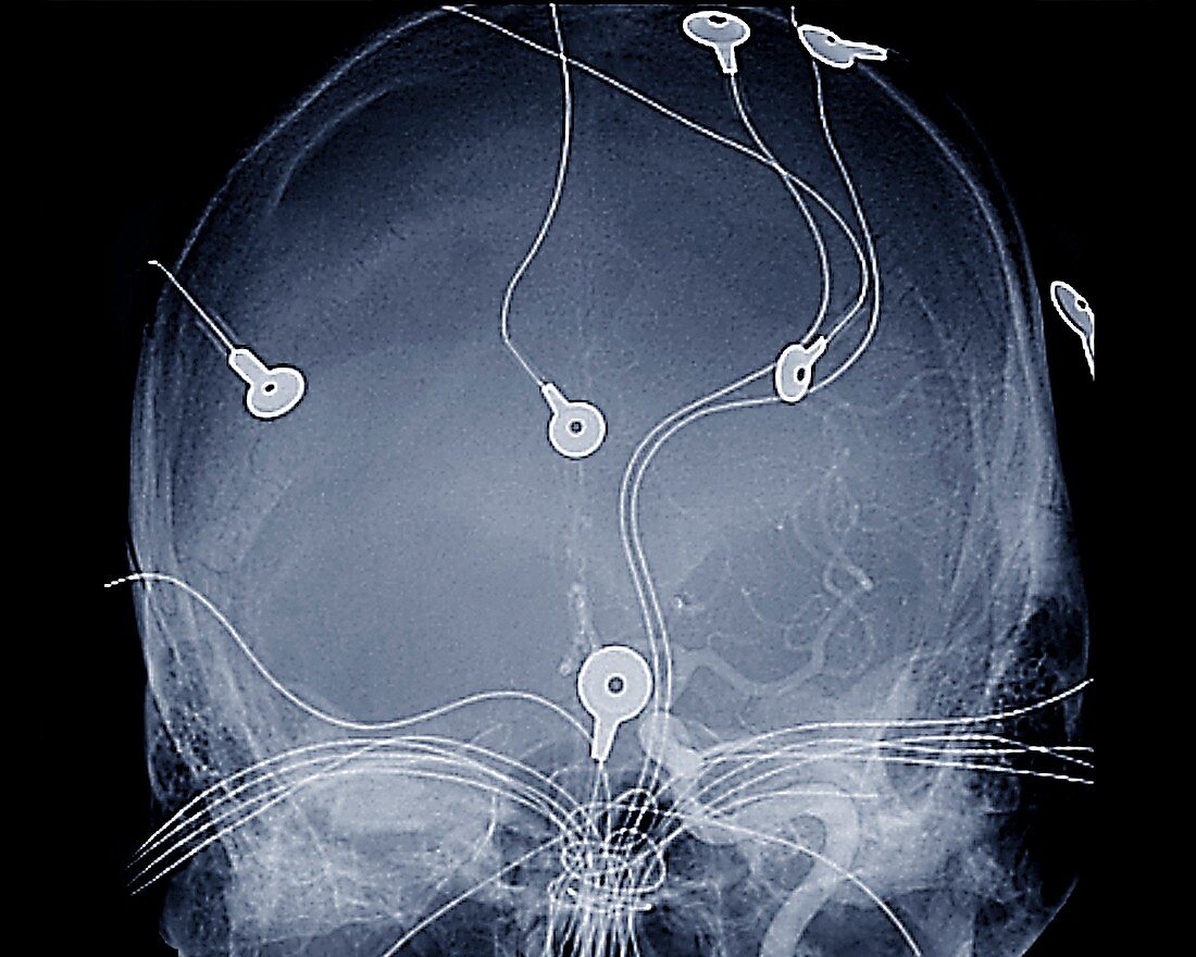 Electroencephalography,angiogram