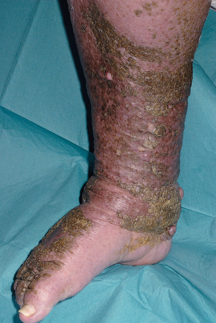 Lymphoedema of the leg