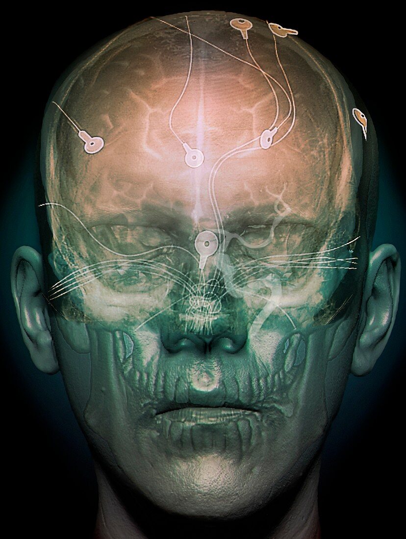 Electroencephalography,3D CT scan