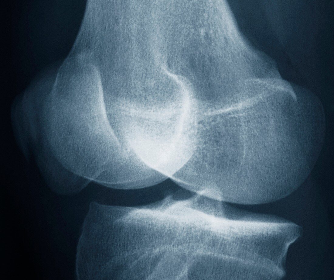 Fractured patella,x-ray