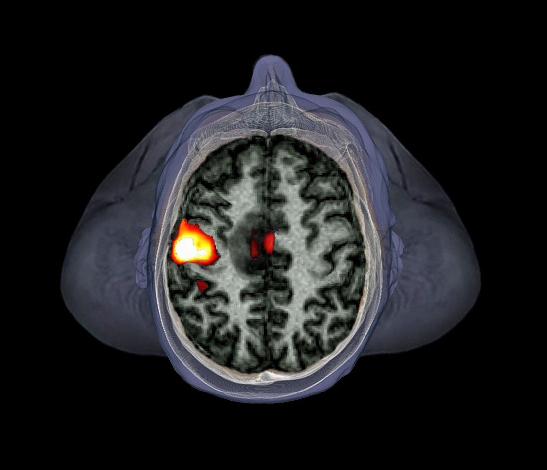 Brain tumour,fMRI scan