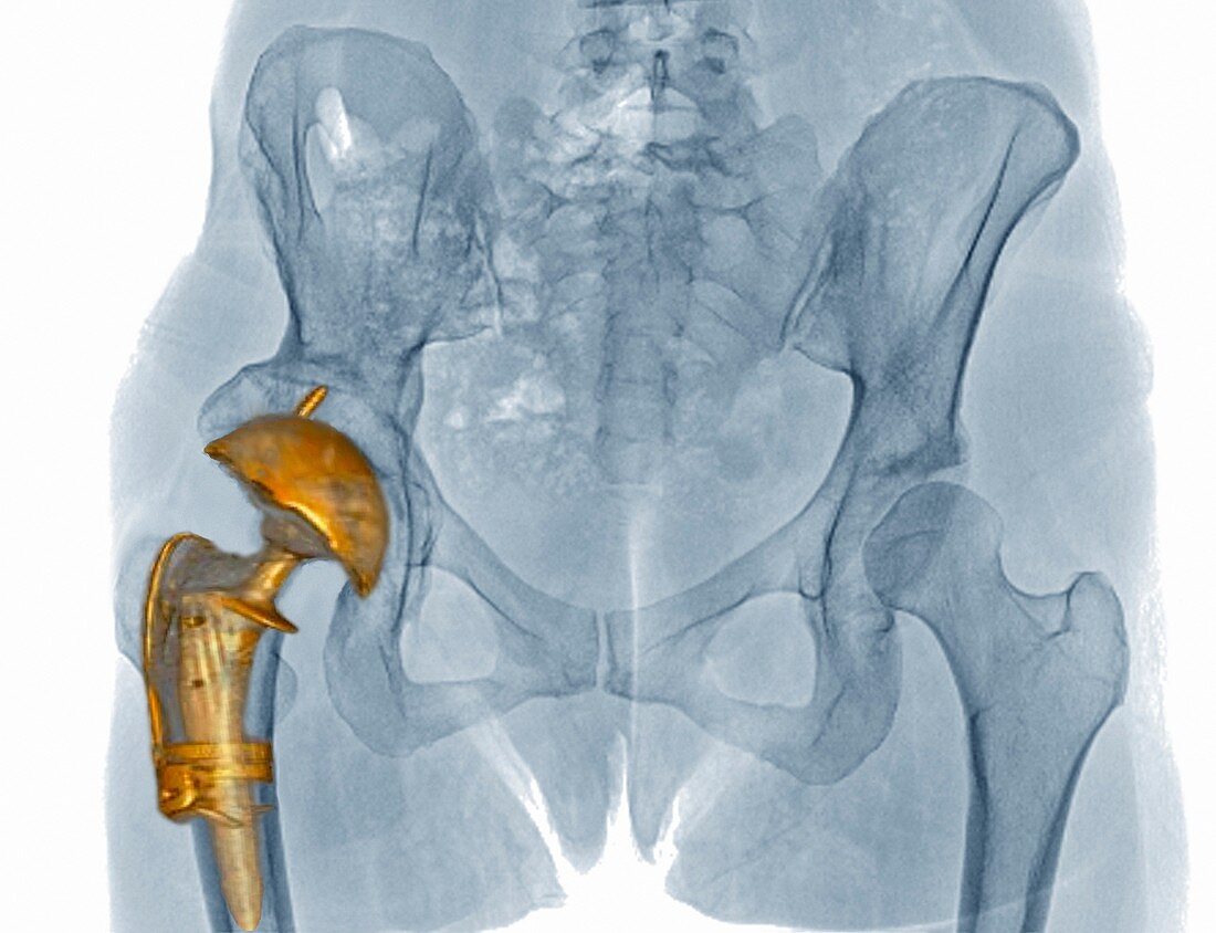 Hip replacement,3D CT scan
