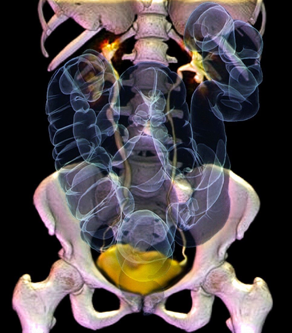 Healthy abdomen,3D CT scan