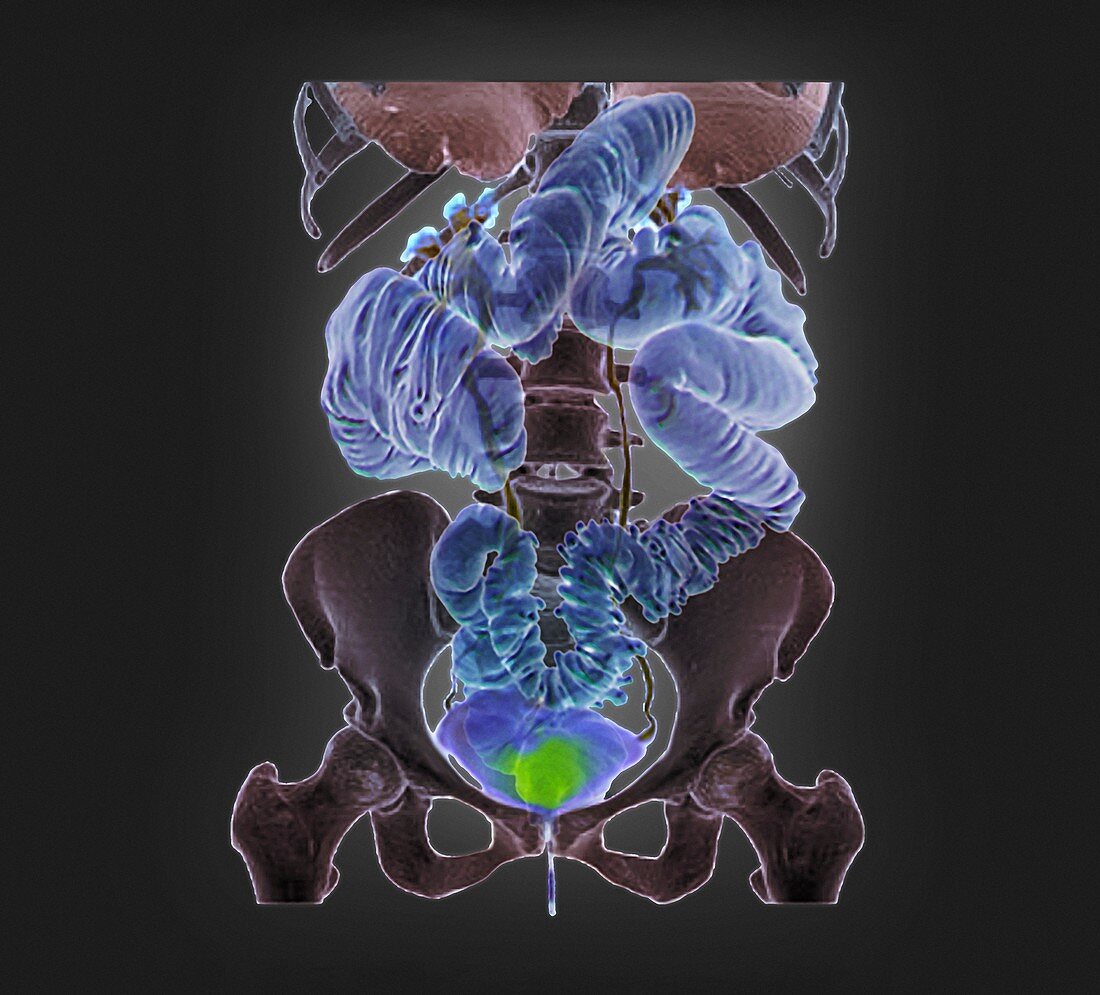 Diverticulosis,3D CT scan