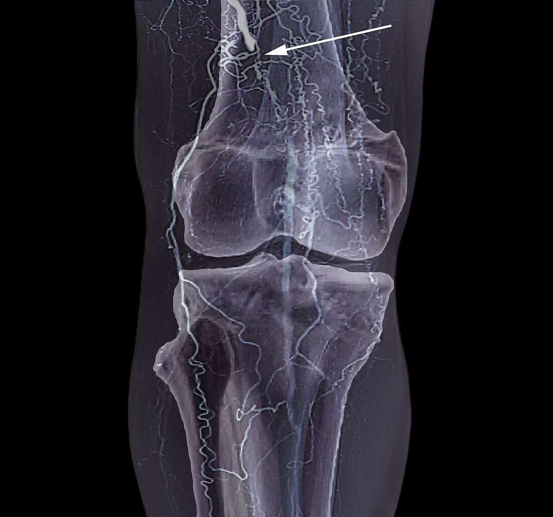 Thrombosis,3D CT angiogram