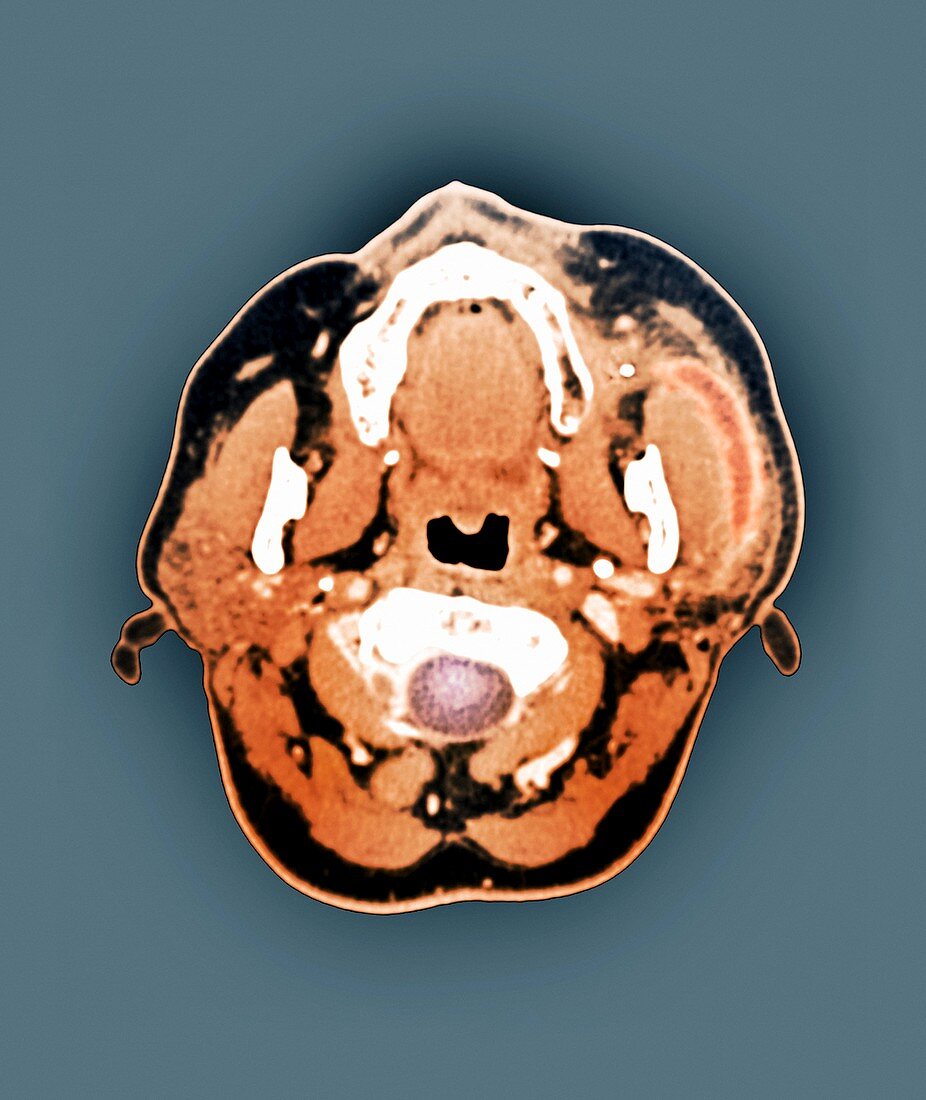 Salivary gland stone,CT scan