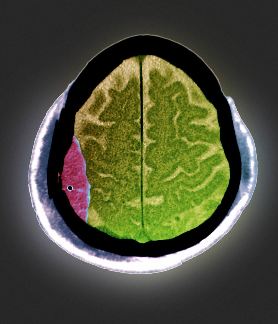 Brain haemorrhage,CT scan