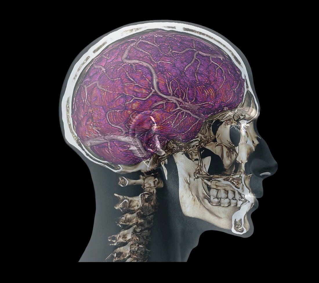 Human head,MRI and 3D CT scans