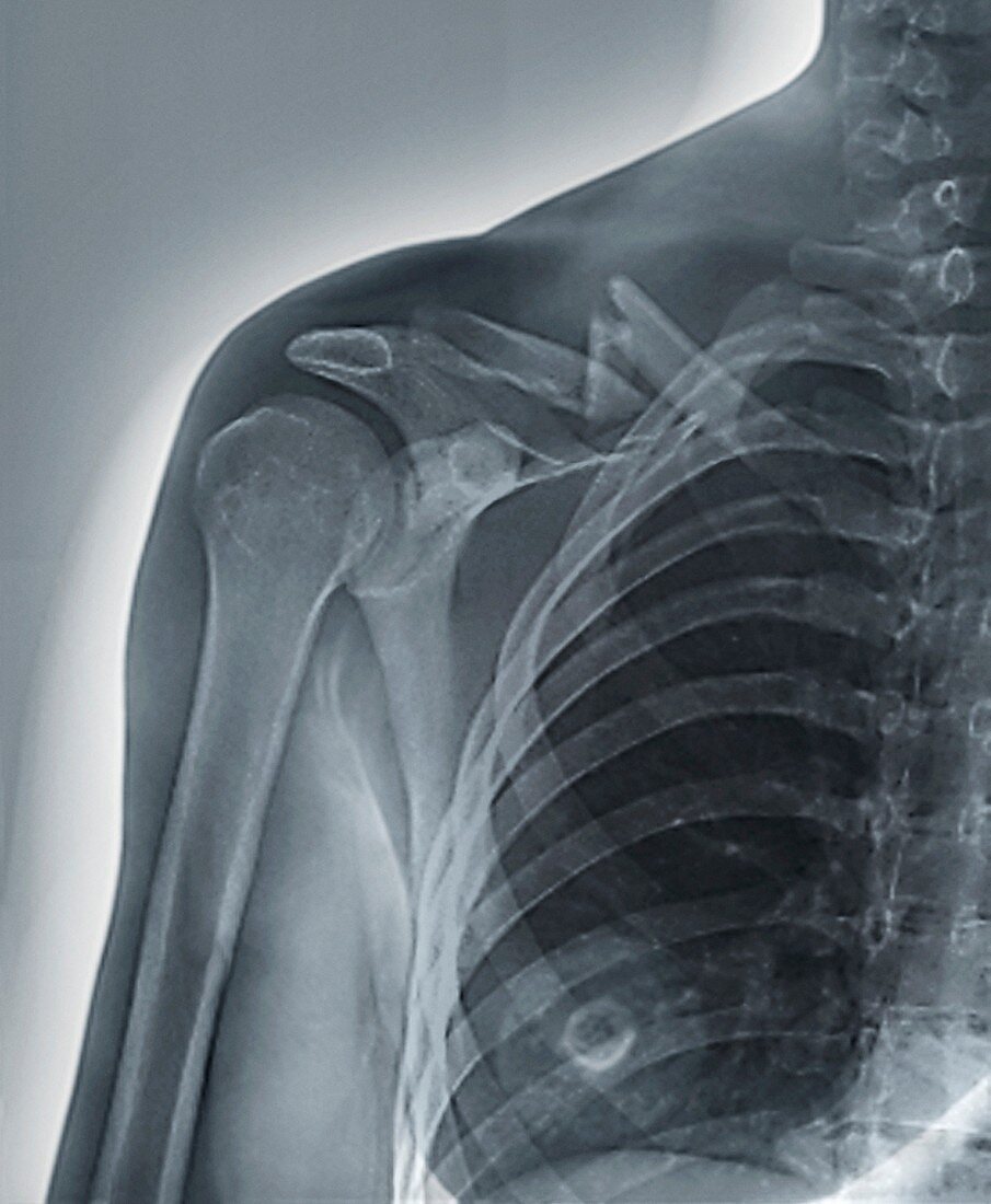 Collar bone fracture,X-ray
