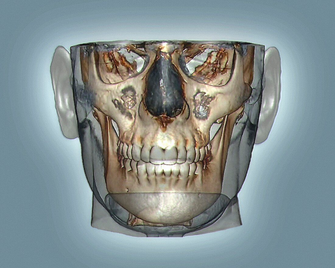 Human head,cone beam CT scan