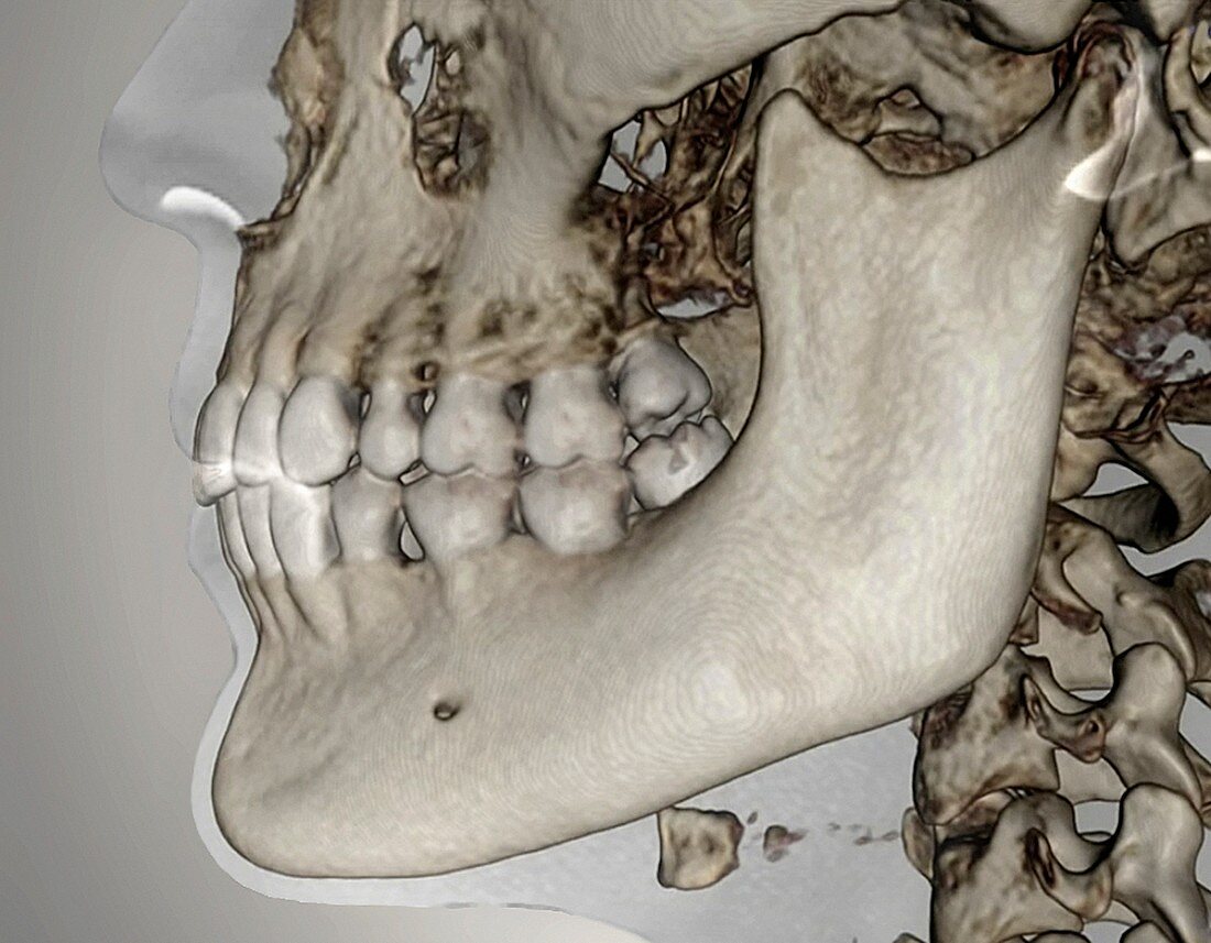 Human jaw,cone beam CT scan