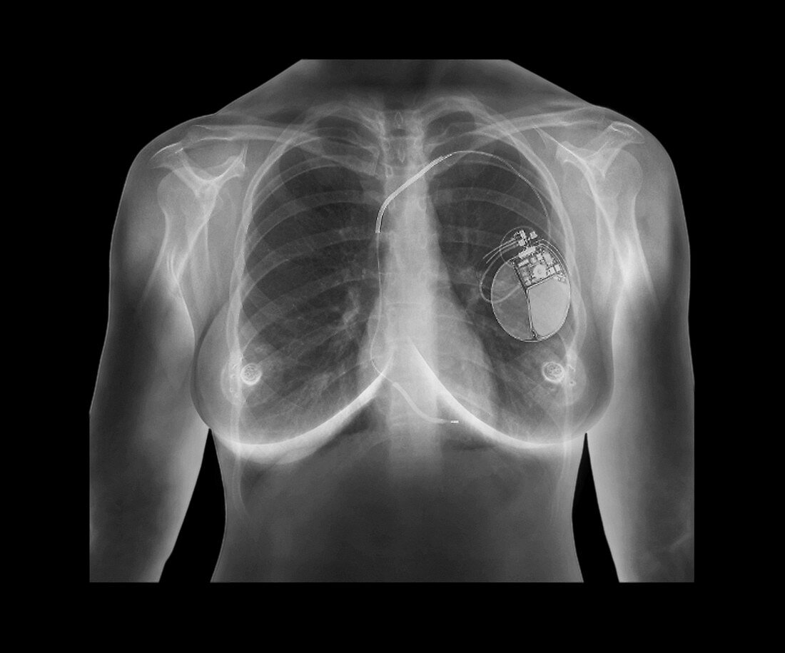 Pacemaker,X-ray