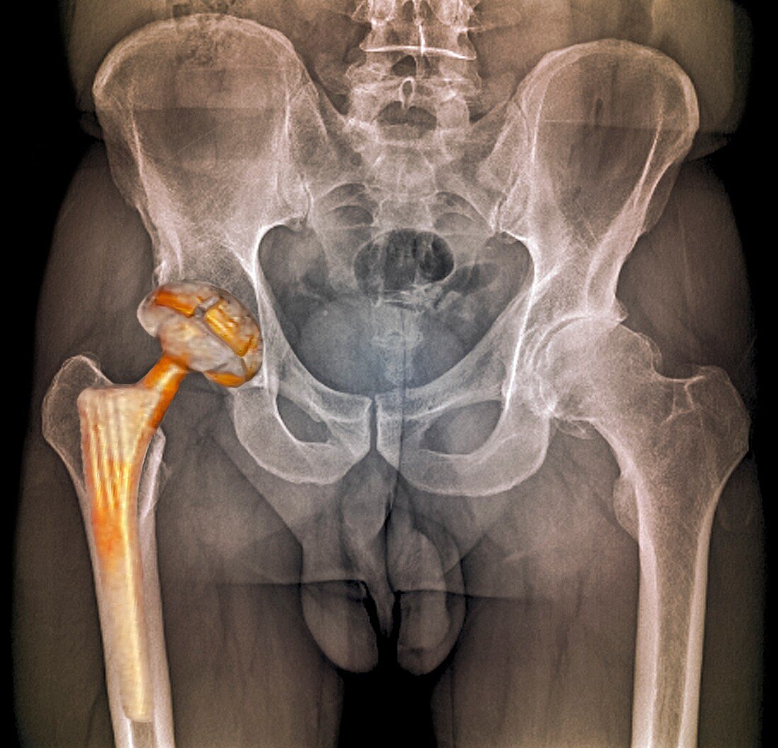 Hip replacement,3D CT scan