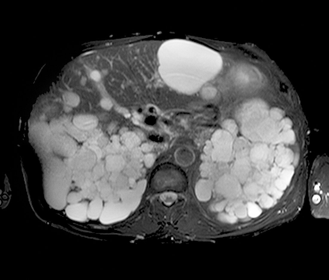 Polycystic disease,MRI scan