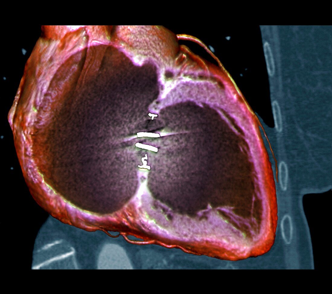 Artificial heart valve,3D CT scan
