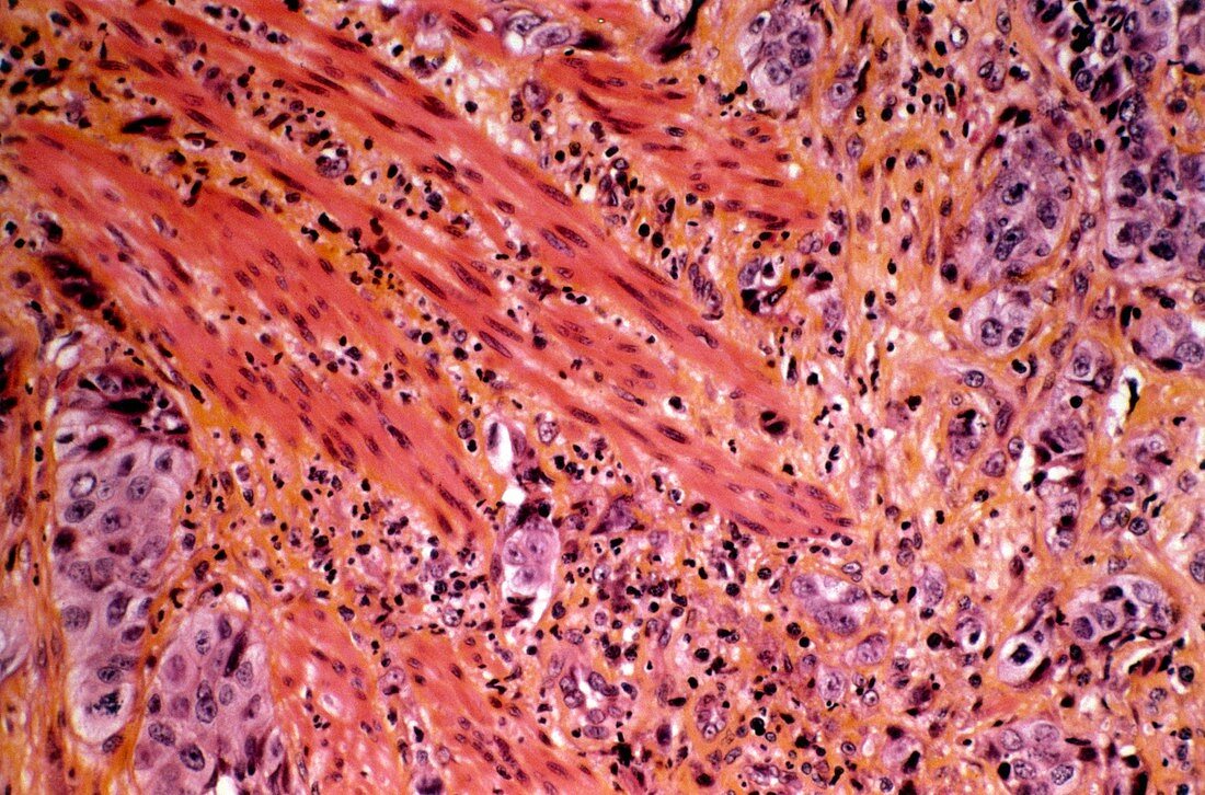 Oesophageal cancer,light micrograph