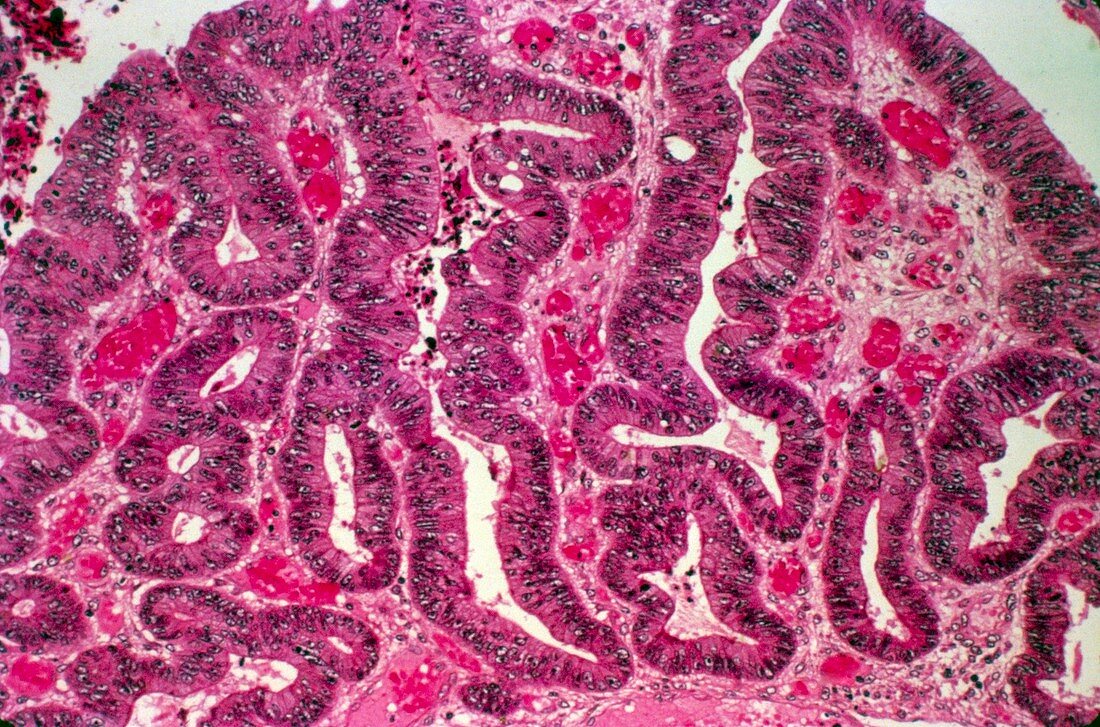 Colon cancer,light micrograph