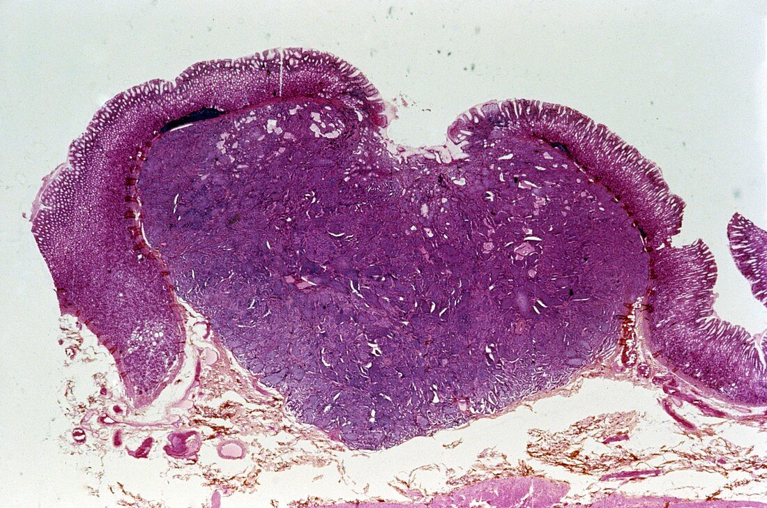 Stomach cancer,light micrograph