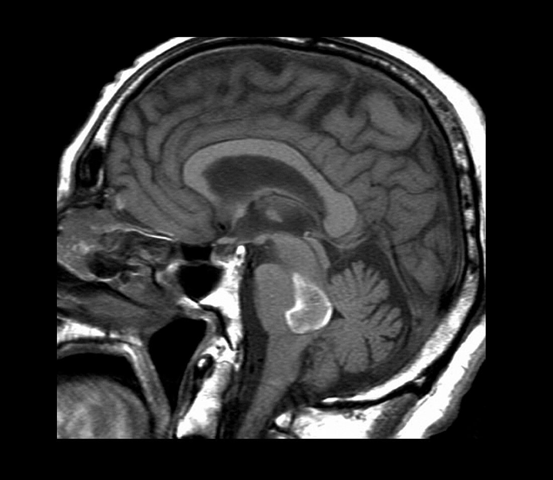 Brain haemorrhage,MRI scan