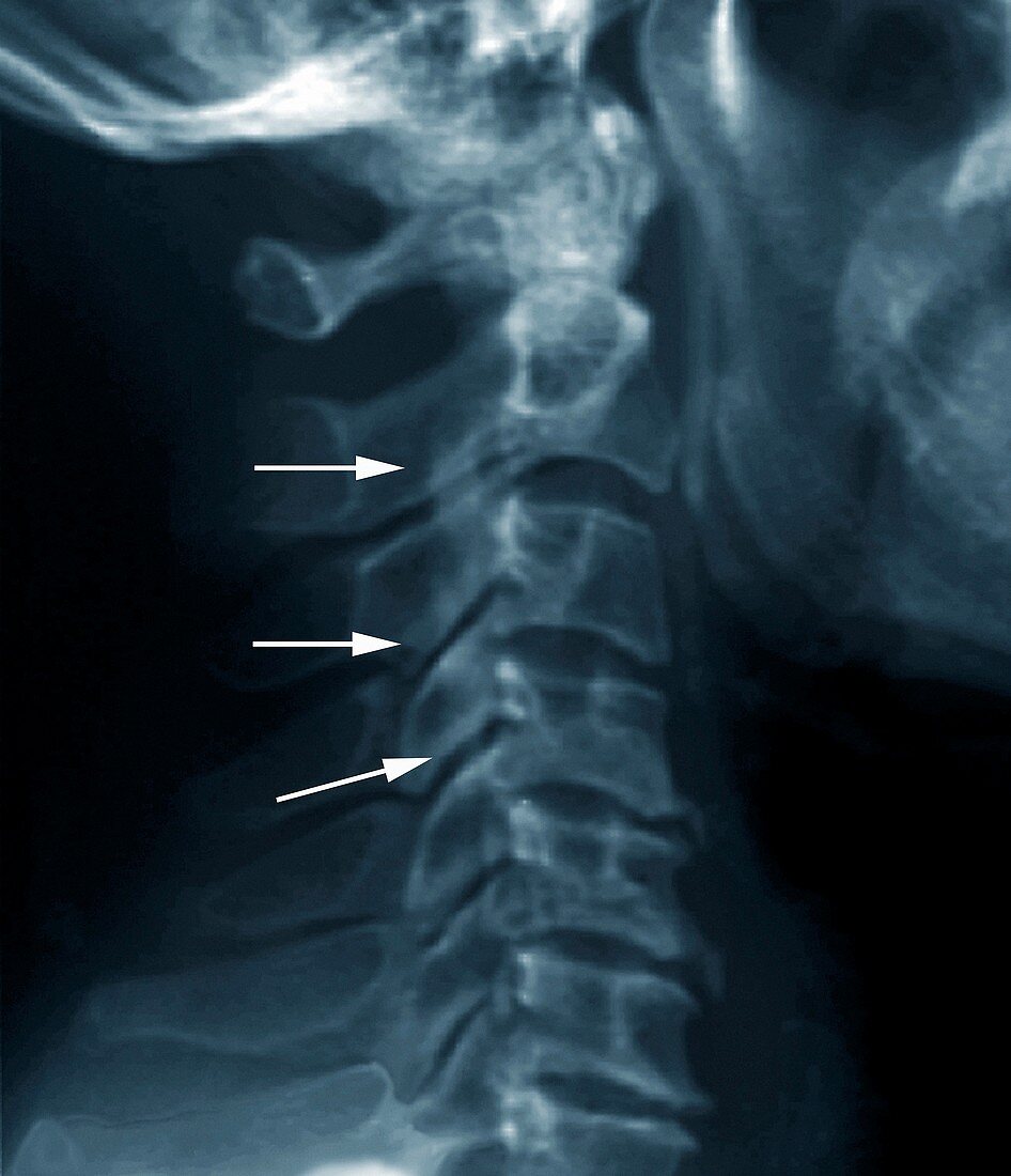 Forestier disease,X-ray