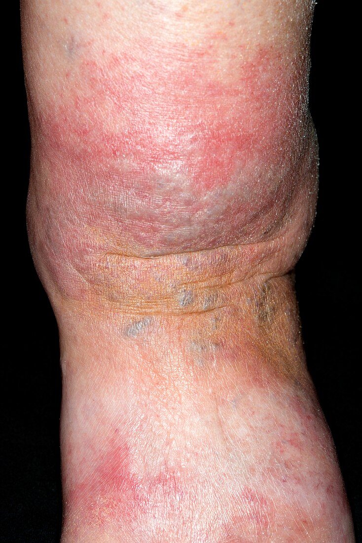Cellulitis affecting the ankle