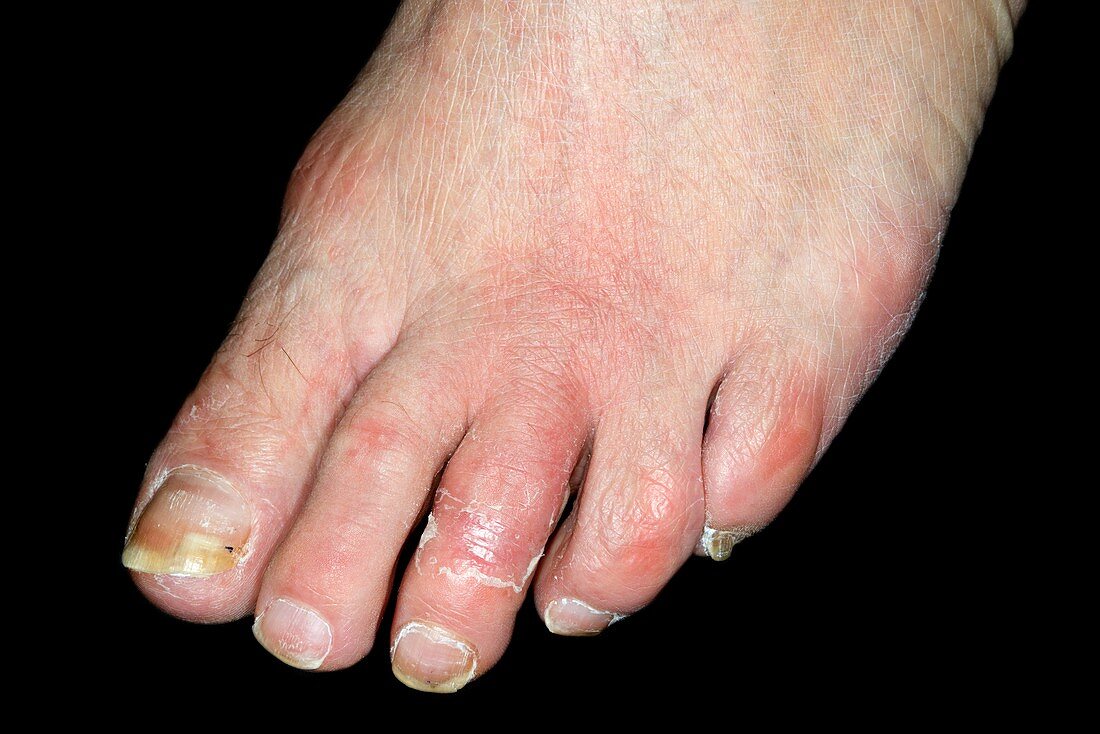 Inflamed foot due to cellulitis